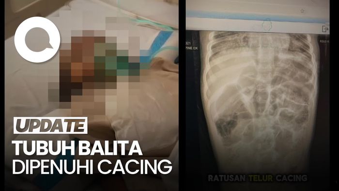 Video: Kisah Pilu Raya, Balita yang Tewas dengan Tubuh Dipenuhi Cacing