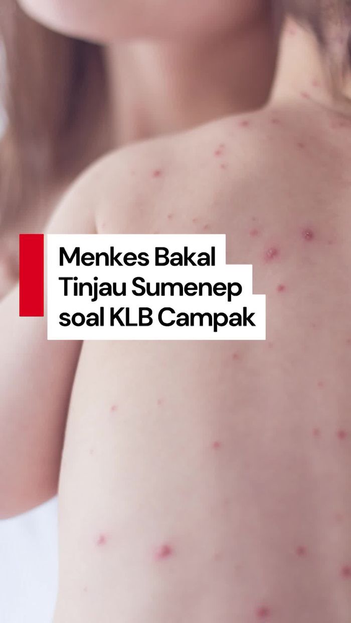 Video: Menkes Bakal Tinjau KLB Campak di Sumenep