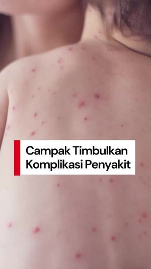 Video: detikers, Campak Bisa Timbulkan Komplikasi Penyakit Serius