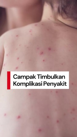 Video: detikers, Campak Bisa Timbulkan Komplikasi Penyakit Serius