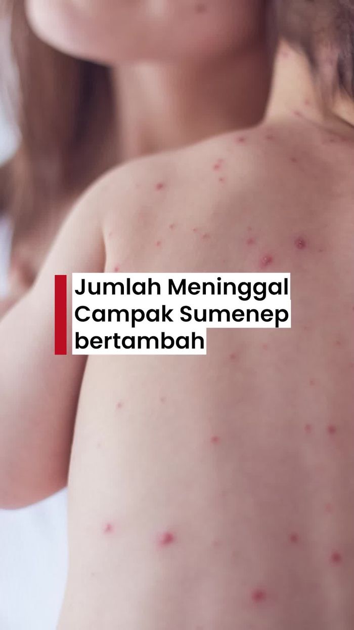 Video: Menkes Sebut Ada 20 Anak Meninggal Akibat Campak Sumenep