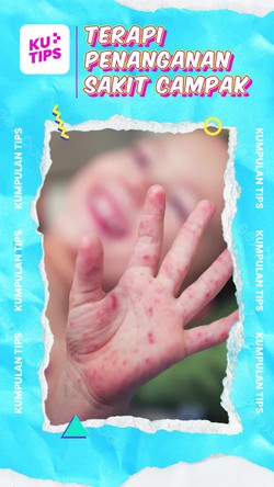 Video KuTips: Terapi Campak pada Anak, IDAI Ingatkan Isolasi Diri 