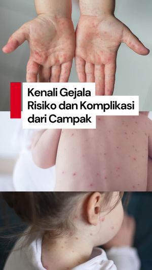 Video Mengenal Seputar Campak: Gejala dan Faktor Risikonya