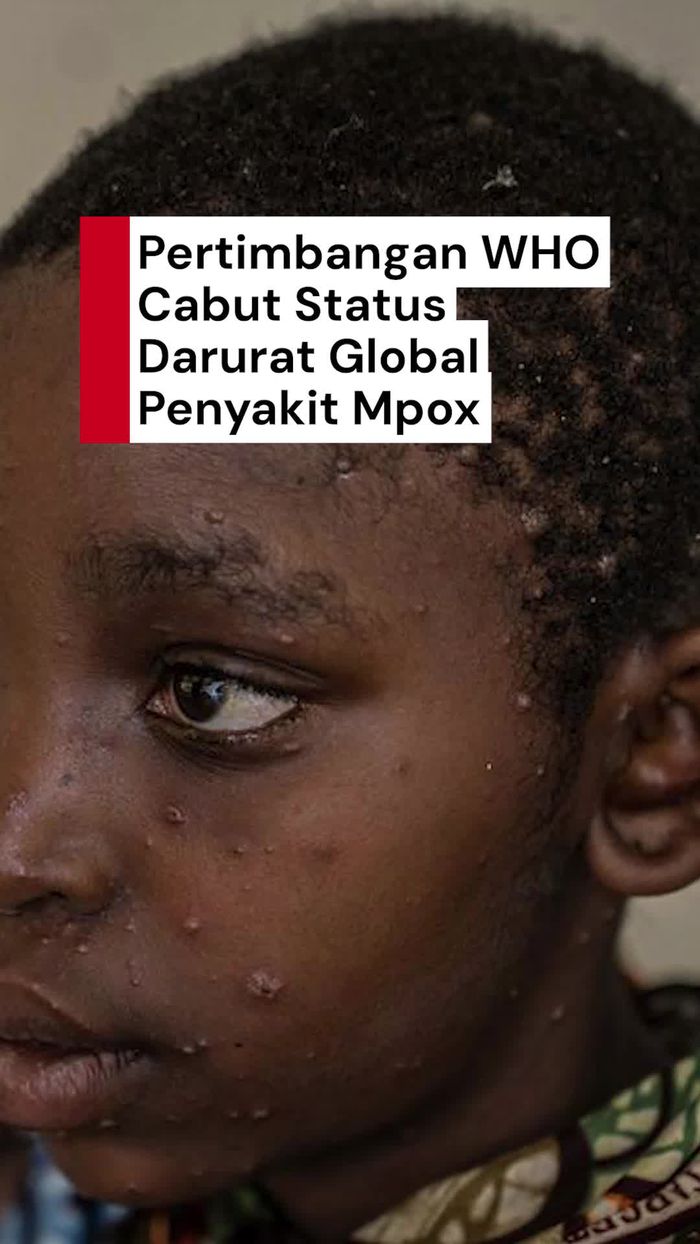 Video: Bahan Pertimbangan WHO Cabut Status Darurat Global Mpox 