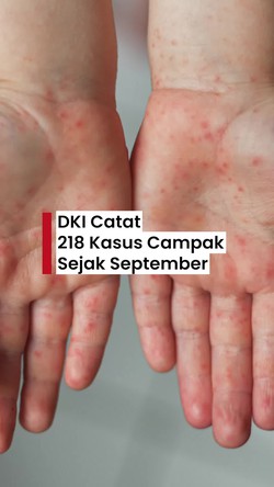 Video: Dinkes DKI Catat Ada 218 Kasus Campak Pada Awal September