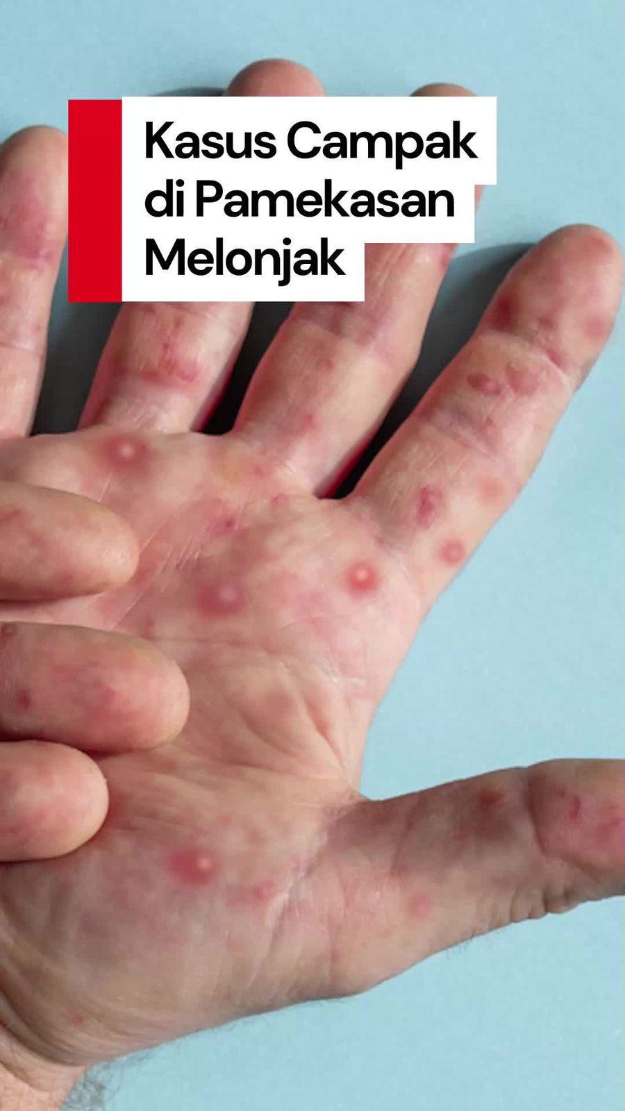 Video: Kasus Suspek Campak di Pamekasan Tembus 500 Orang